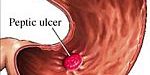 peptic-ulcer