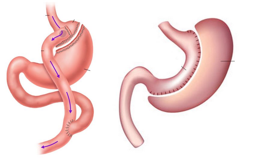 Gastric Bypass Vs. Gastric Sleeve Weight Loss Surgery 5000x2880