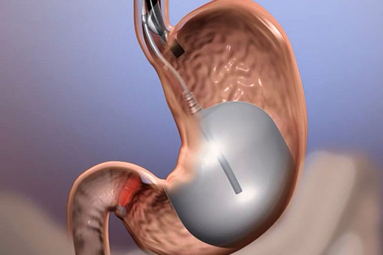 ht 150521 spatz medical balloon intergastric 800x600