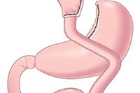 lap roux en y gastric bypass