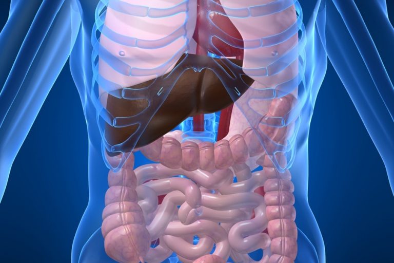 diverticulosis