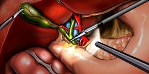 laparascopic cholecystectomy laparascopic cholecystectomy