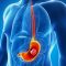 dt 141106 stomach cancer 800x600