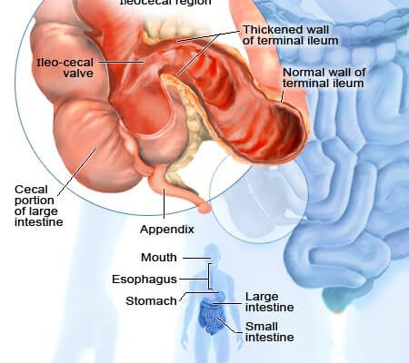 2011-crohns-disease