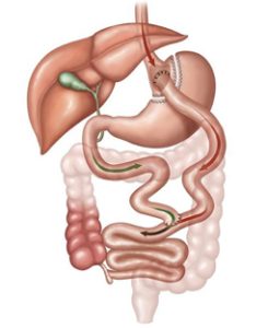 BAR_GastricBypass_cropped