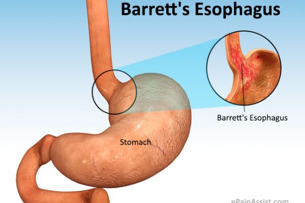 Barretts-Esophagus