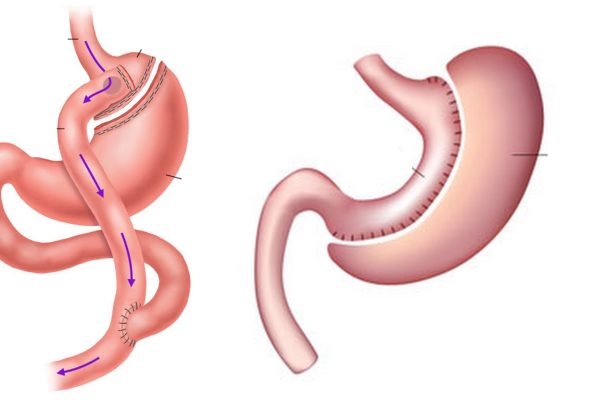 Gastric Bypass Vs. Gastric Sleeve Weight Loss Surgery