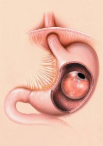 Intragastric_Balloon_img_1862