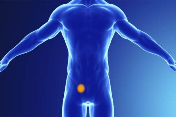 Przepuklina-pachwinowa-1