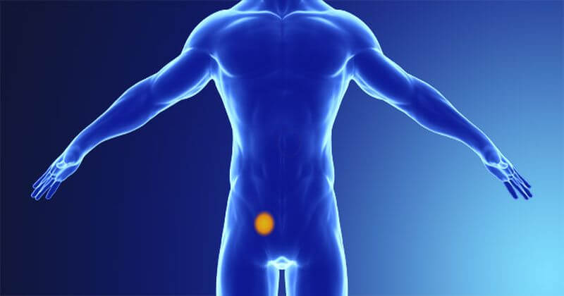 Przepuklina-pachwinowa-1