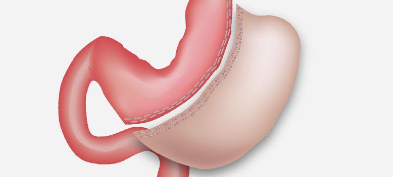 Sleeve-Gastrectomy