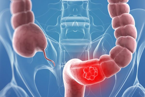 colon-cancer-screening