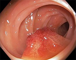 colon cancer