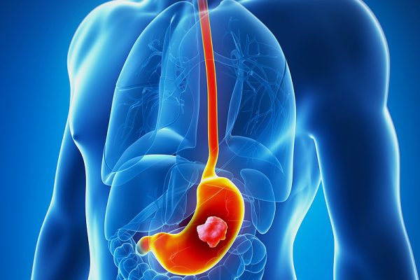 dt_141106_stomach_cancer_800x600