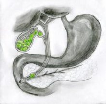 Gallbladder with stones