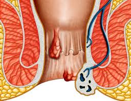 hemorrhoids