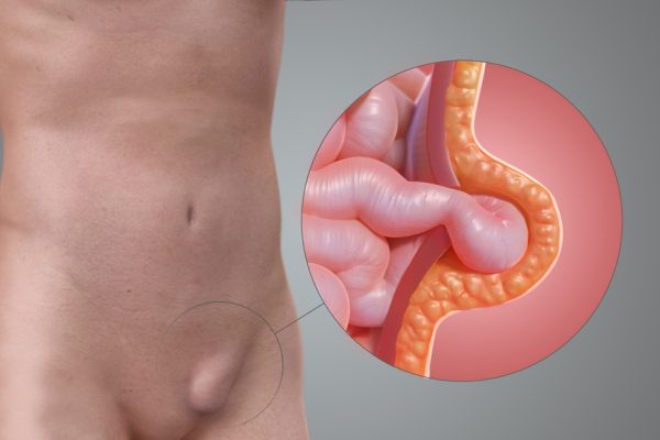 inguinal-hernia-1