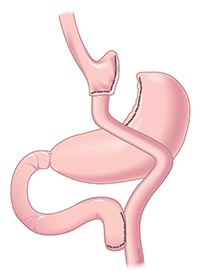 lap-roux-en-y-gastric-bypass