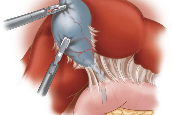 laparoscopic-cholecystecomy-b