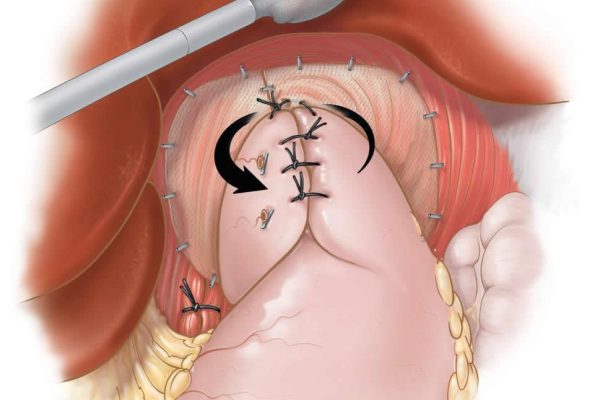 laparoscopic-fundoplication