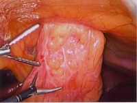 Лапароскопия при херния