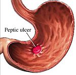 peptic-ulcer