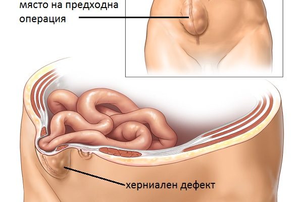 sledoperativna_hernia