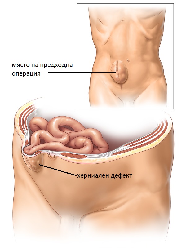 sledoperativna_hernia